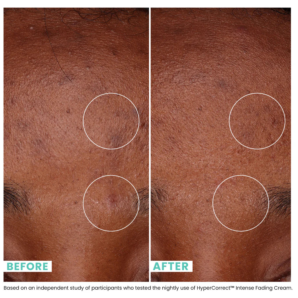 Urban Skin Rx HyperCorrect Intense Fading Cream Skin Fades